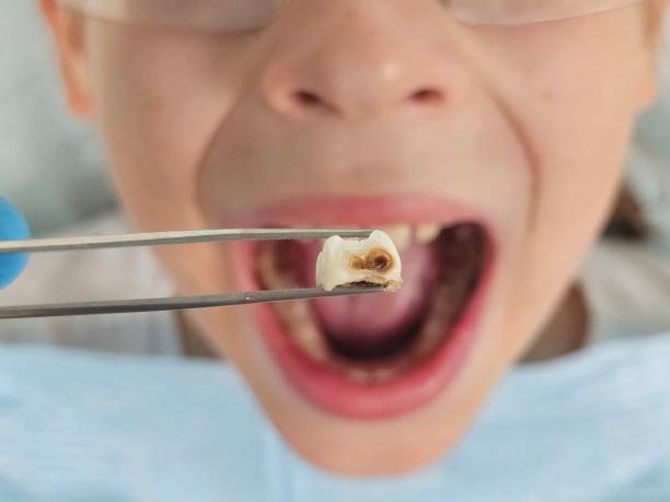 Best Emergency Treatment for Dental Infections or Abscesses in Hamilton, AL